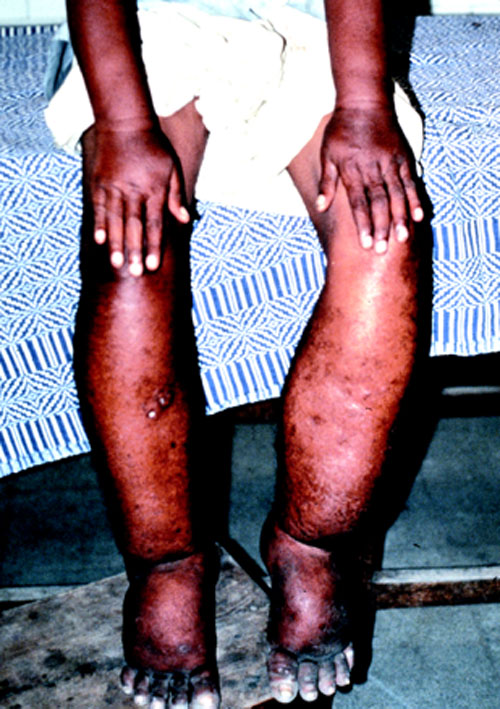 YIKES, LYMPHATIC FILARIAE Worms 