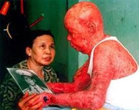 agent orange man A Vietmnamese victim of Agent Orange, dramatically demonstrating one of the dermatological expressions of the disease.