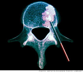 A colored CT scan of a single vertebra (as seen from above) during a vertebroplasty. The term refers to a procedure, used to treat compression fractures, in which a surgeon injects bone cement (the white material coming out of the needle) into the spine to reinforce the bone and prevent future damage. A colored CT scan of a single vertebra (as seen from above) during a vertebroplasty. The term refers to a procedure, used to treat compression fractures, in which a surgeon injects bone cement (the white material coming out of the needle) into the spine to reinforce the bone and prevent future damage.